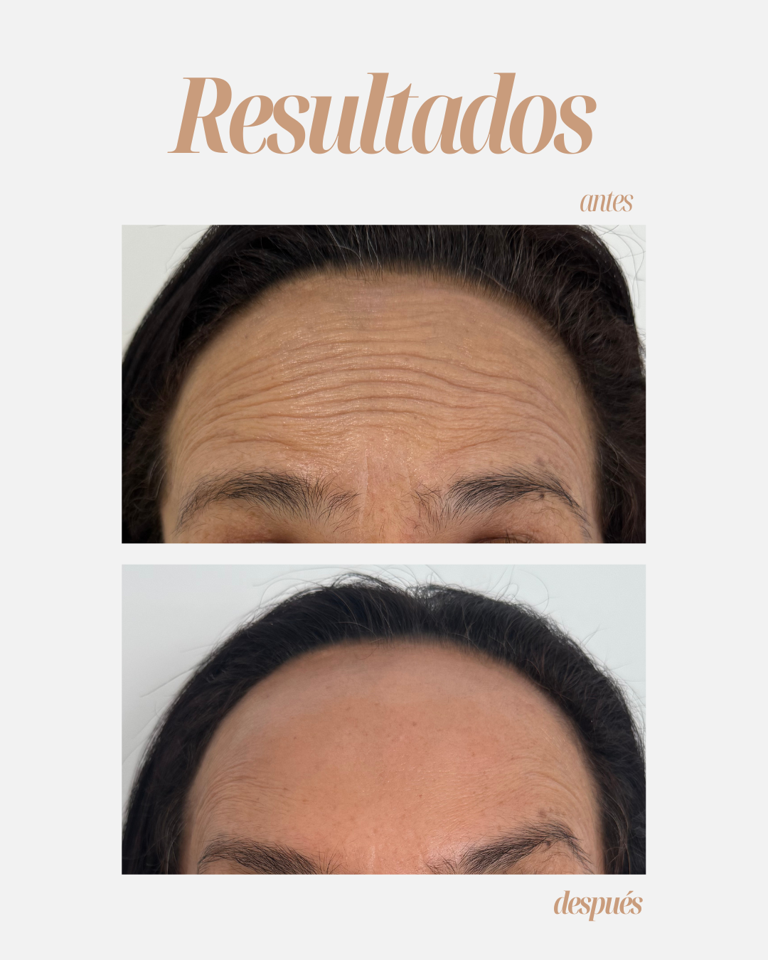 Resultado real - Rejuvenecimiento
